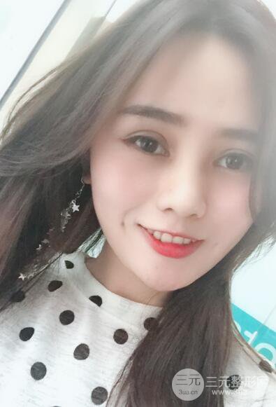 松原齊飛整形割雙眼皮真人案例前后對(duì)比圖日扎分享