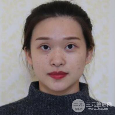 哈爾濱哈美萊鄭東學(xué)隆鼻整形案例對(duì)比圖真實(shí)心情分享喲~