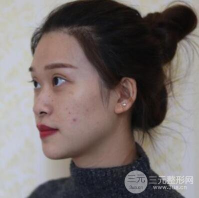 哈爾濱哈美萊鄭東學(xué)隆鼻整形案例對(duì)比圖真實(shí)心情分享喲~