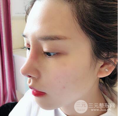 哈爾濱哈美萊鄭東學(xué)隆鼻整形案例對(duì)比圖真實(shí)心情分享喲~