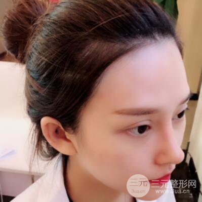 哈爾濱哈美萊鄭東學(xué)隆鼻整形案例對(duì)比圖真實(shí)心情分享喲~