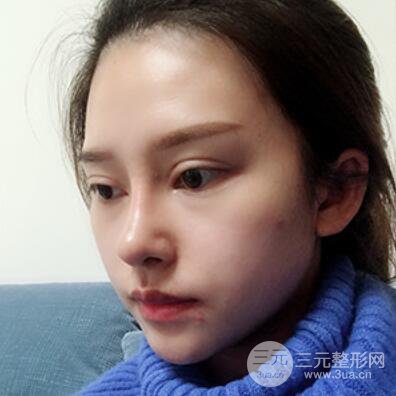 哈爾濱哈美萊鄭東學(xué)隆鼻整形案例對(duì)比圖真實(shí)心情分享喲~