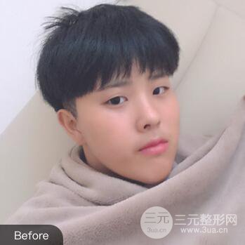 哈醫(yī)大二院整形科肖志波割雙眼皮對比圖男性案例