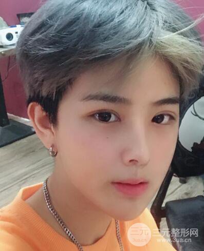 哈醫(yī)大二院整形科肖志波割雙眼皮對比圖男性案例