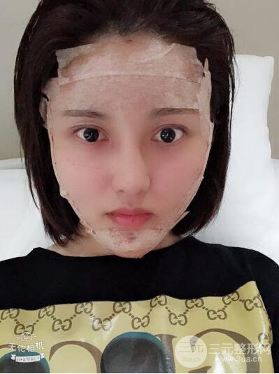 常州施爾美廉鋒自體脂肪豐臉對照圖案例心情日扎