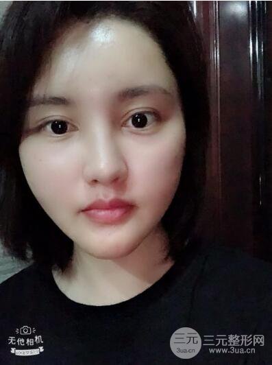 常州施爾美廉鋒自體脂肪豐臉對照圖案例心情日扎