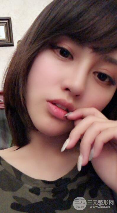 常州施爾美廉鋒自體脂肪豐臉對照圖案例心情日扎