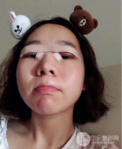 湘潭華美切開雙眼皮案例對照圖兩個月恢復(fù)過程心情日扎