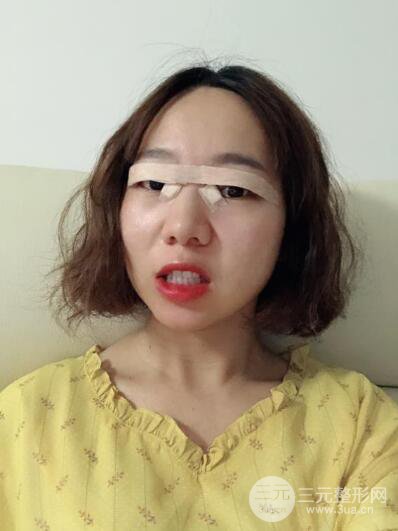 湘潭華美切開雙眼皮案例對照圖兩個月恢復(fù)過程心情日扎