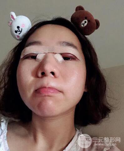 湘潭華美切開雙眼皮案例對照圖兩個月恢復(fù)過程心情日扎