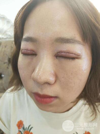 湘潭華美切開雙眼皮案例對照圖兩個月恢復(fù)過程心情日扎