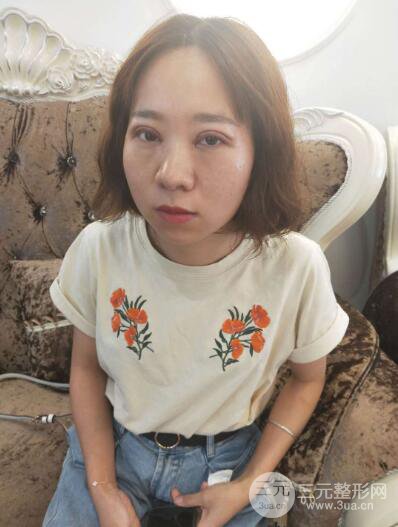 湘潭華美切開雙眼皮案例對照圖兩個月恢復(fù)過程心情日扎