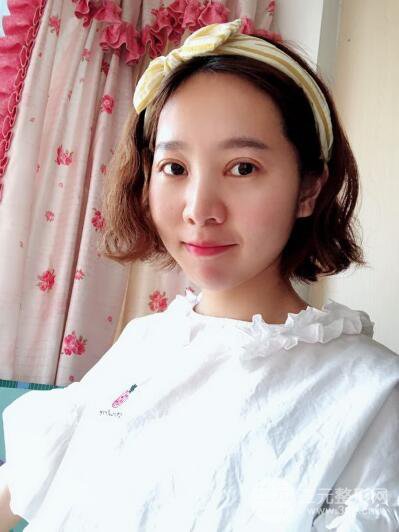 湘潭華美切開雙眼皮案例對照圖兩個月恢復(fù)過程心情日扎