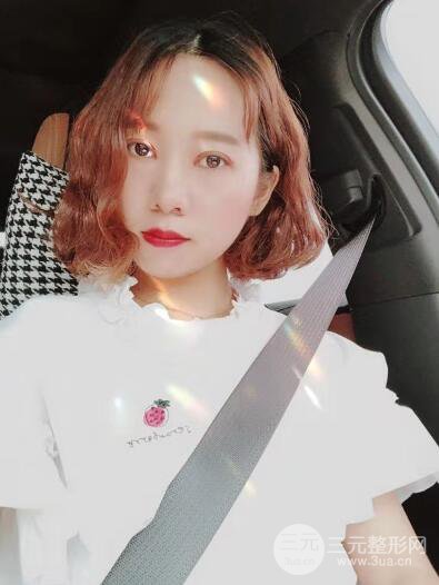 湘潭華美切開雙眼皮案例對照圖兩個月恢復(fù)過程心情日扎