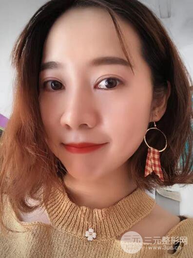 湘潭華美切開雙眼皮案例對照圖兩個月恢復(fù)過程心情日扎