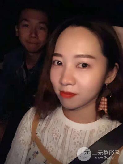 湘潭華美切開雙眼皮案例對照圖兩個月恢復(fù)過程心情日扎