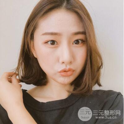 西安葉子魯禮新埋線雙眼皮案例對(duì)照?qǐng)D!兩個(gè)月恢復(fù)心情小記