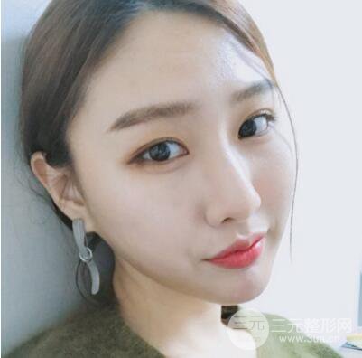 西安葉子魯禮新埋線雙眼皮案例對(duì)照?qǐng)D!兩個(gè)月恢復(fù)心情小記