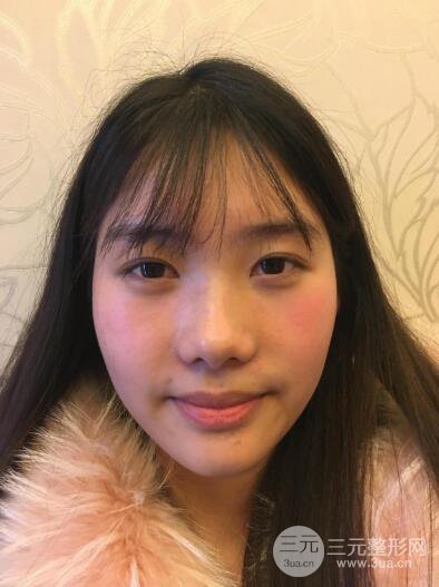 蘇州紫馨孫影塌鼻子假體隆鼻案例對比照心情小札