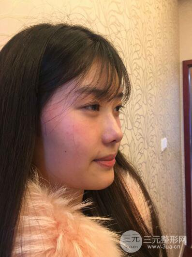 蘇州紫馨孫影塌鼻子假體隆鼻案例對比照心情小札