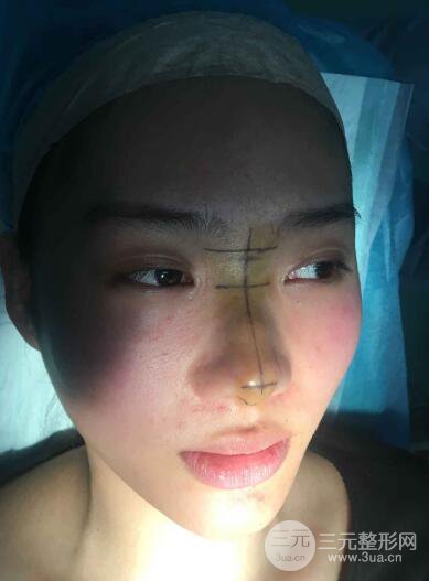 蘇州紫馨孫影塌鼻子假體隆鼻案例對比照心情小札
