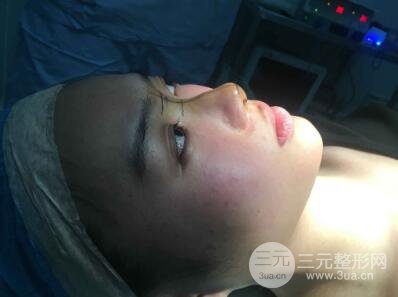 蘇州紫馨孫影塌鼻子假體隆鼻案例對比照心情小札