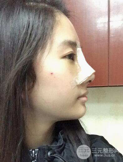 蘇州紫馨孫影塌鼻子假體隆鼻案例對比照心情小札