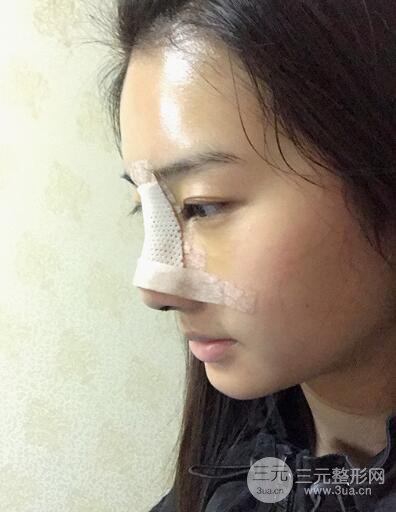 蘇州紫馨孫影塌鼻子假體隆鼻案例對比照心情小札