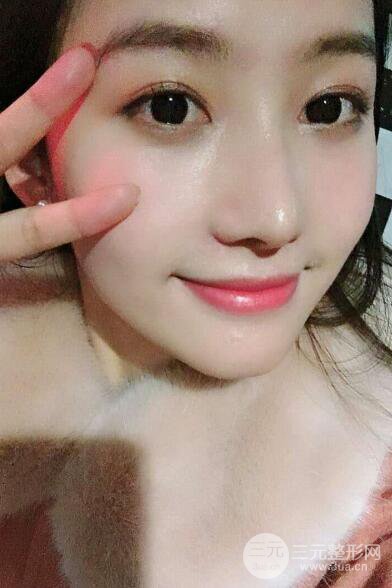 蘇州紫馨孫影塌鼻子假體隆鼻案例對比照心情小札