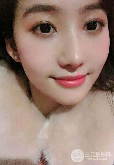 蘇州紫馨孫影塌鼻子假體隆鼻案例對比照心情小札