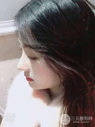 蘇州紫馨孫影塌鼻子假體隆鼻案例對比照心情小札