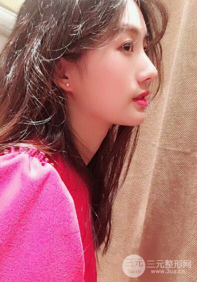 蘇州紫馨孫影塌鼻子假體隆鼻案例對比照心情小札