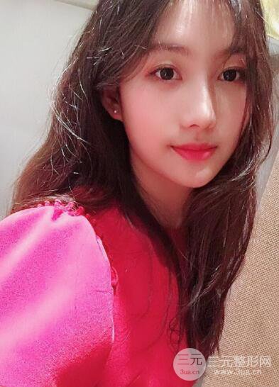 蘇州紫馨孫影塌鼻子假體隆鼻案例對比照心情小札