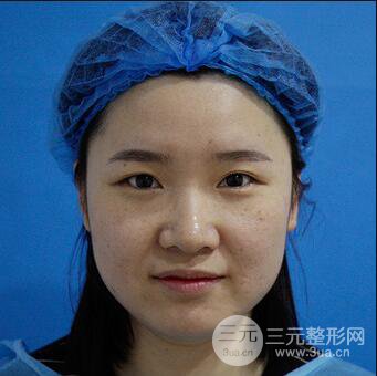 貴陽美萊梁潔芭比媚雙眼皮多項(xiàng)整形前后對比圖恢復(fù)心情小札