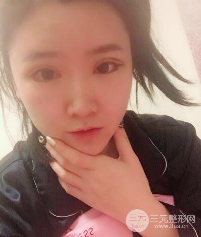 貴陽美萊梁潔芭比媚雙眼皮多項(xiàng)整形前后對比圖恢復(fù)心情小札