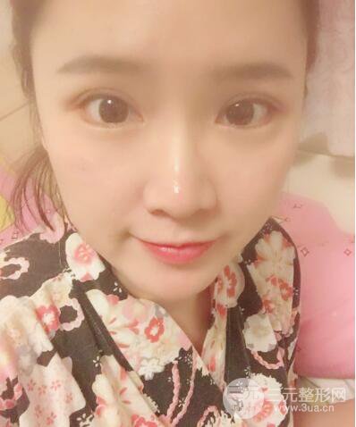 貴陽美萊梁潔芭比媚雙眼皮多項(xiàng)整形前后對比圖恢復(fù)心情小札