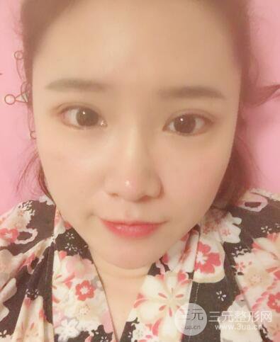 貴陽美萊梁潔芭比媚雙眼皮多項(xiàng)整形前后對比圖恢復(fù)心情小札