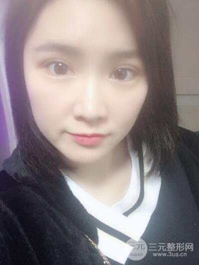 貴陽美萊梁潔芭比媚雙眼皮多項(xiàng)整形前后對比圖恢復(fù)心情小札