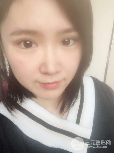 貴陽美萊梁潔芭比媚雙眼皮多項(xiàng)整形前后對比圖恢復(fù)心情小札