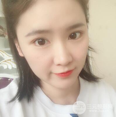 貴陽美萊梁潔芭比媚雙眼皮多項(xiàng)整形前后對比圖恢復(fù)心情小札