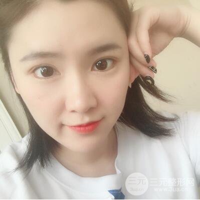 貴陽美萊梁潔芭比媚雙眼皮多項(xiàng)整形前后對比圖恢復(fù)心情小札