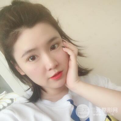 貴陽美萊梁潔芭比媚雙眼皮多項(xiàng)整形前后對比圖恢復(fù)心情小札