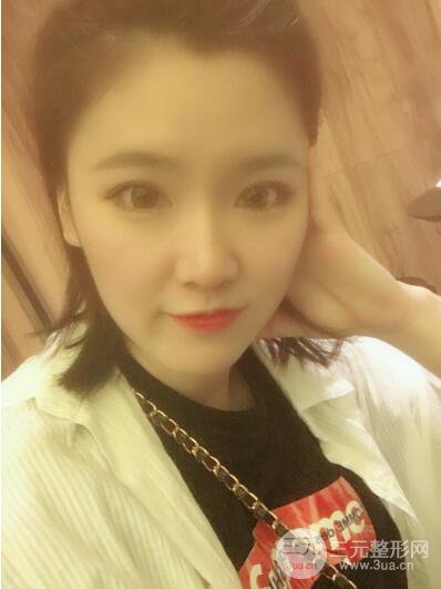 貴陽美萊梁潔芭比媚雙眼皮多項(xiàng)整形前后對比圖恢復(fù)心情小札