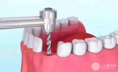 種植牙后注意哪些問題?種植牙后的注意事項(xiàng)有哪些?