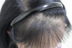 植發(fā)后遺癥有哪些?植發(fā)有后遺癥嗎?