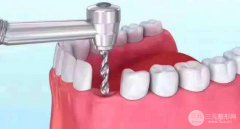 種植牙和鑲牙哪個(gè)更好?