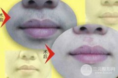 激光去唇毛管用嗎?靠譜嗎?