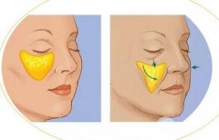 玻尿酸填充淚溝的危害有哪些?