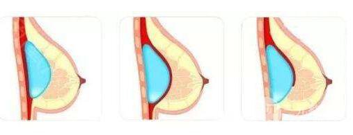 假體隆胸疤痕增生怎么辦