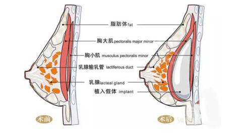 蜜桃假體隆胸的危害性